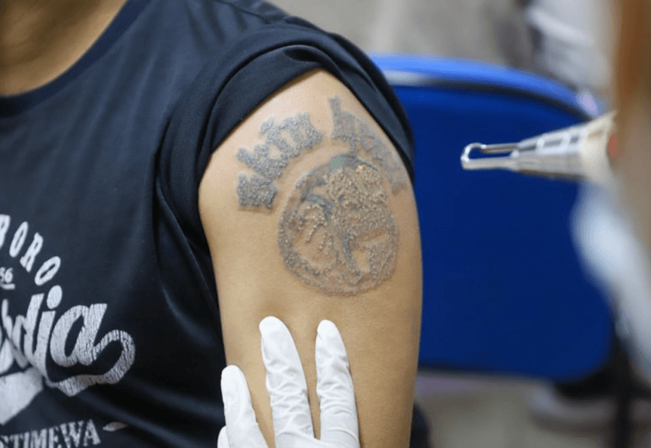 Hijrah Hapus Tato dan Bekam